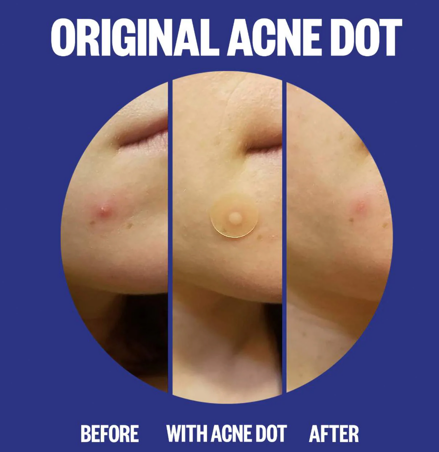 Peace Out Acne Salicylic Acid Day & Night Duo