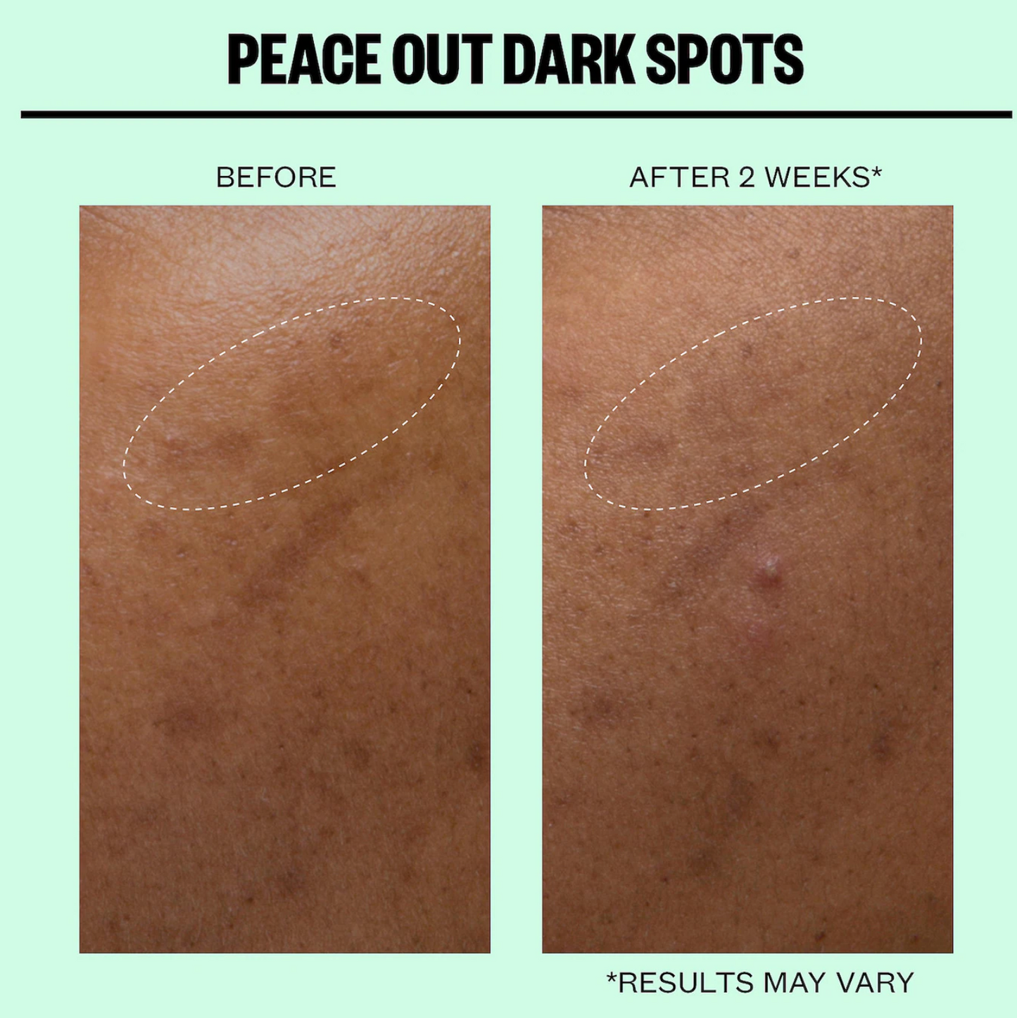 Peace Out Microneedling Dark Spot Brightening Dots
