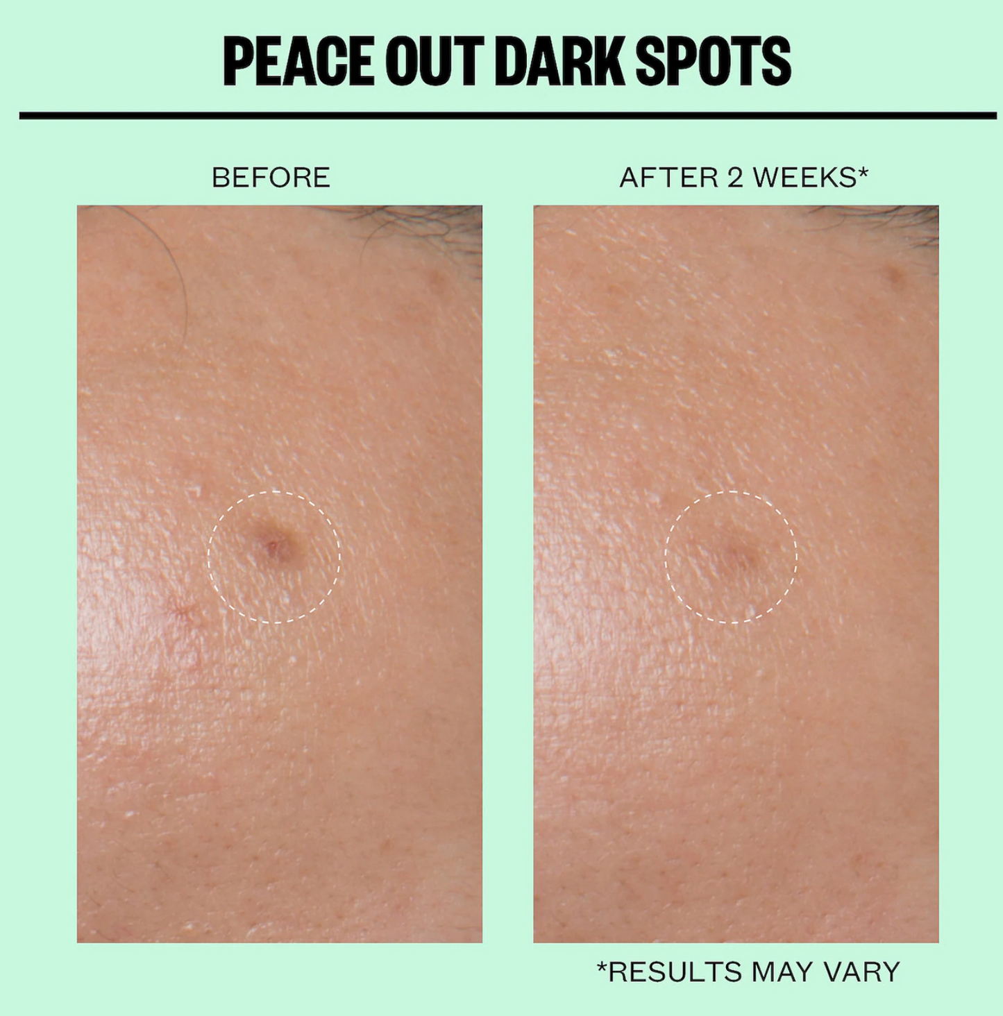 Peace Out  Microneedling Dark Spot Brightening Dots