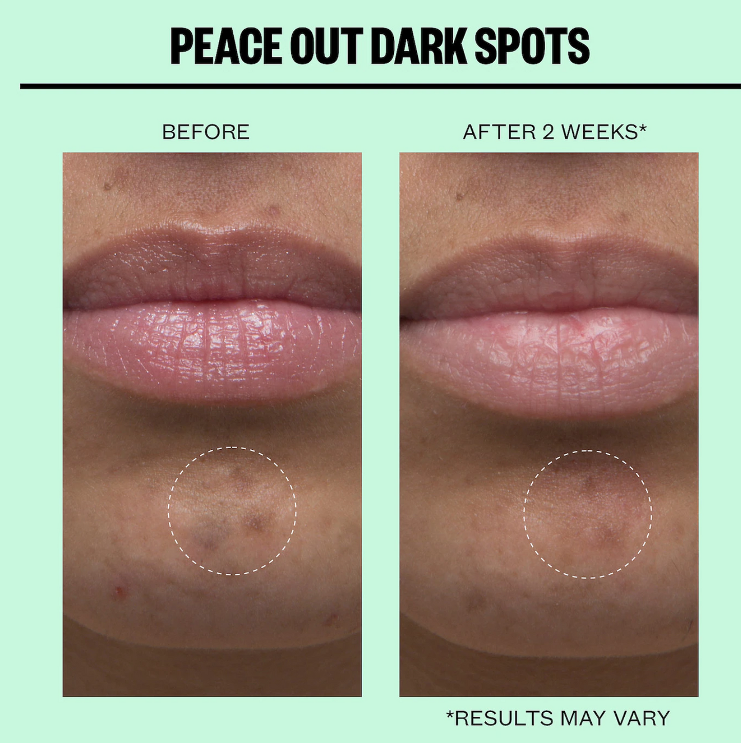 Peace Out  Microneedling Dark Spot Brightening Dots