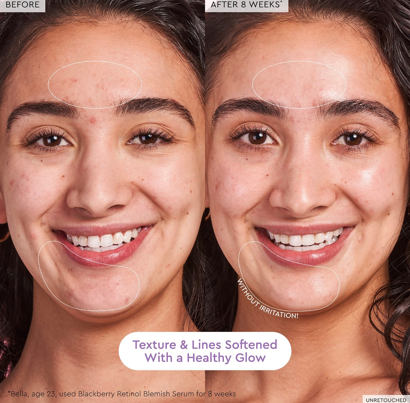 BlackBerry Retinol Blemish Serum Glow Recipe