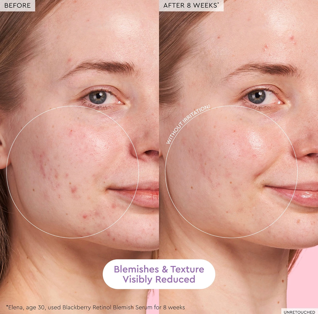 BlackBerry Retinol Blemish Serum Glow Recipe
