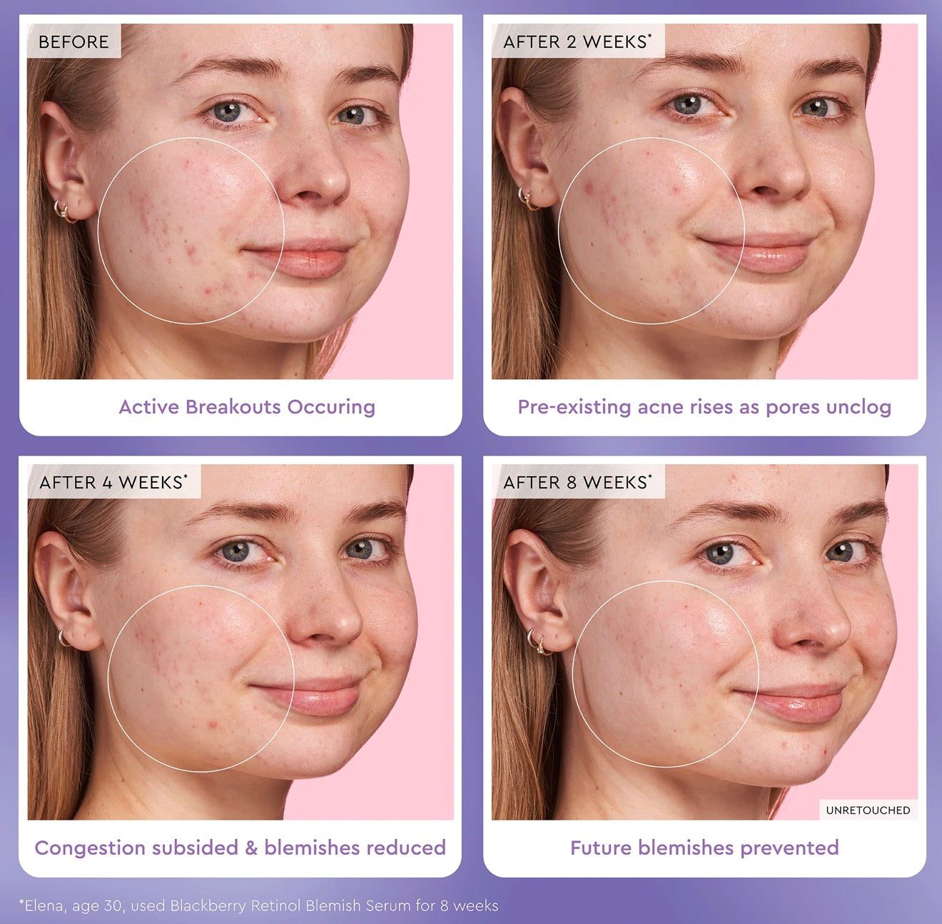 BlackBerry Retinol Blemish Serum Glow Recipe